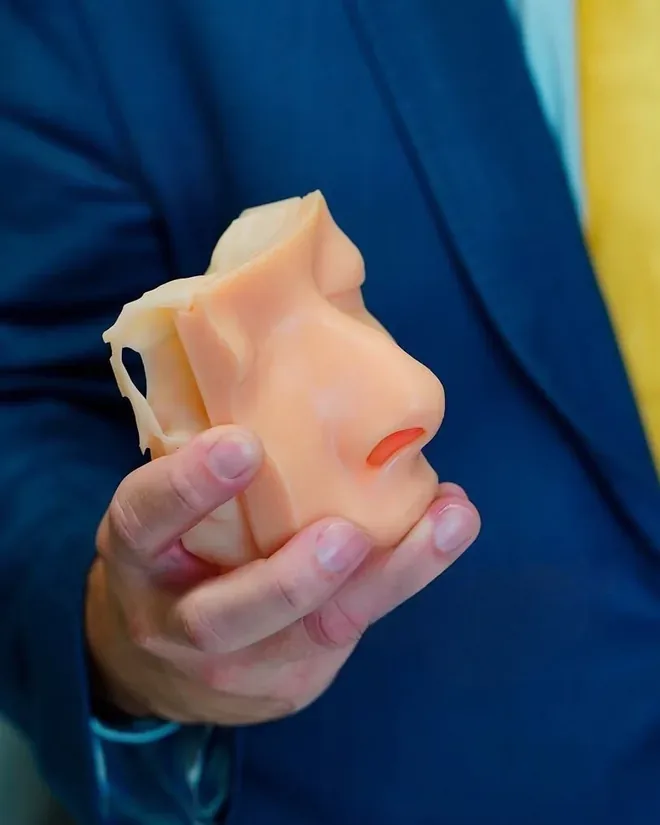 Molde de prótese nasal utilizado no planejamento de rinoplastia